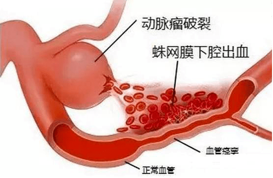 虹网，构建未来数字世界的桥梁虹网膜下腔出血
